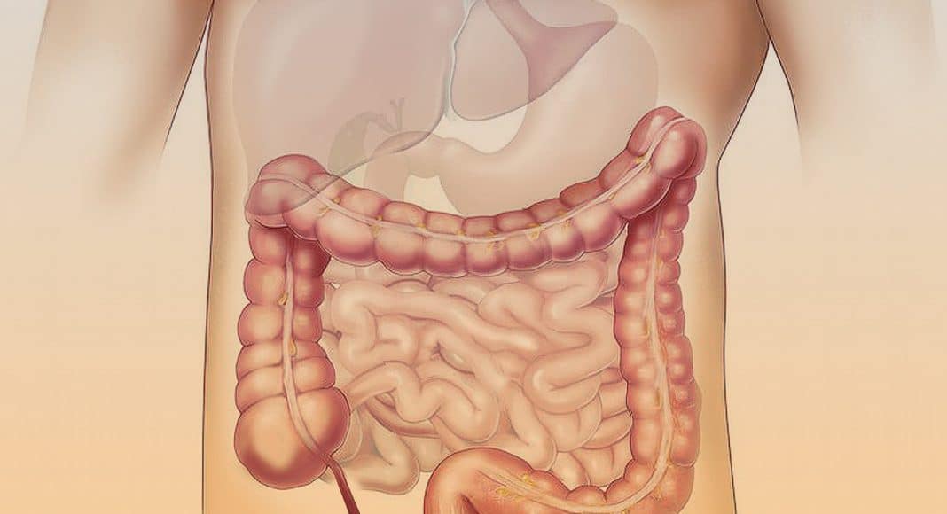 Crohn’s