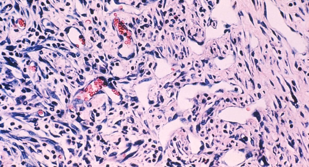 Marijuana, HIV And Kaposi’s Sarcoma: What You Should Know