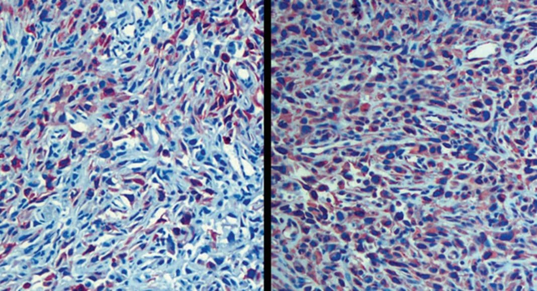 bladder cancer