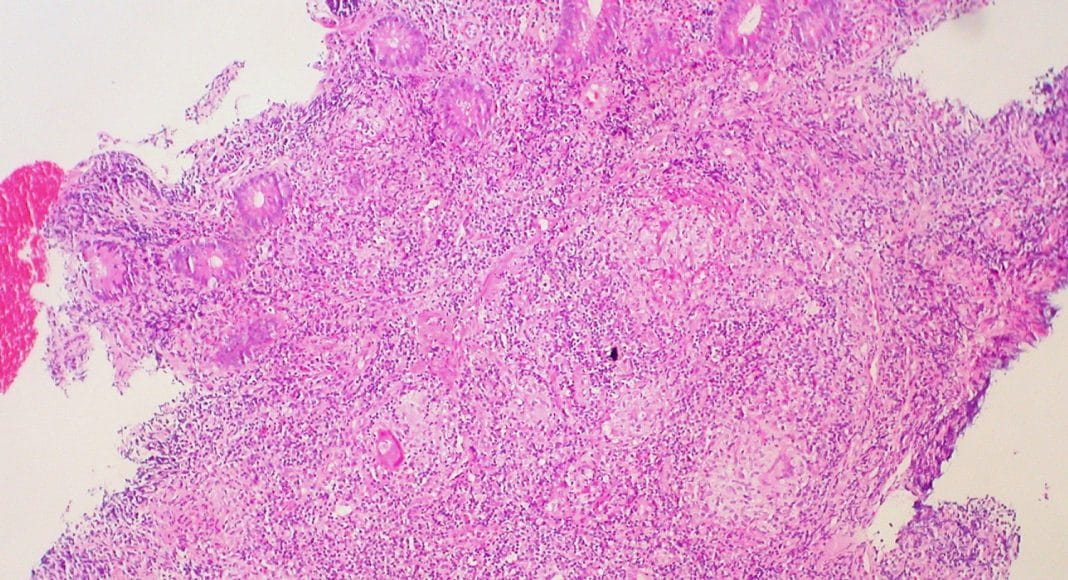Crohn’s Disease