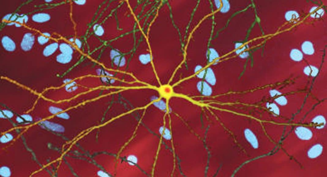 Huntington’s Disease