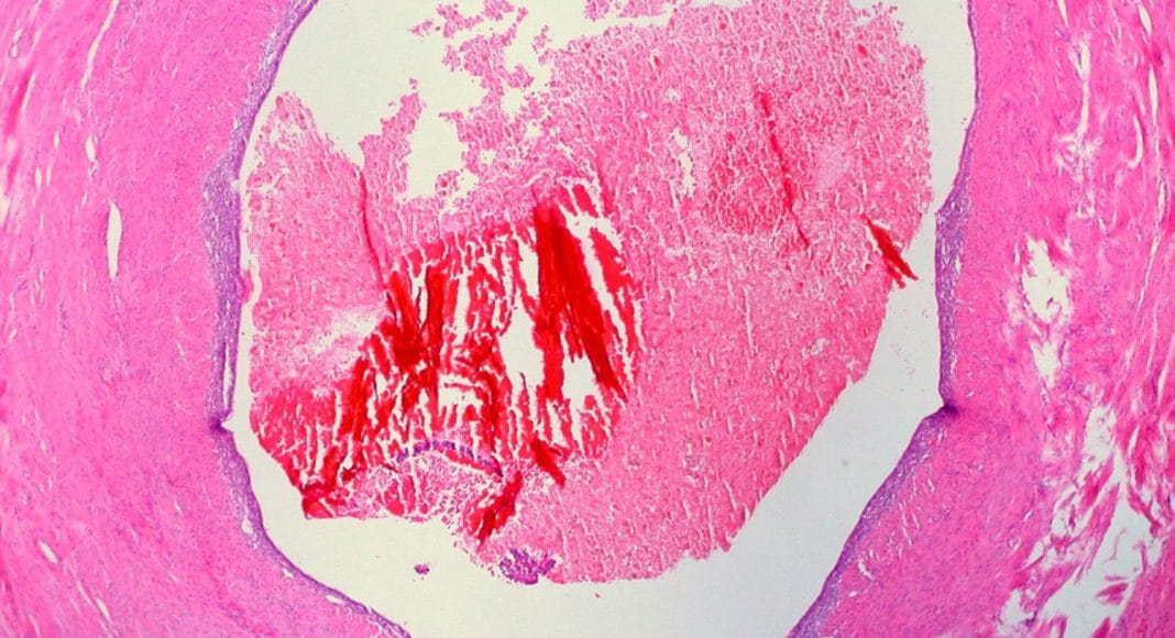 endometriosis
