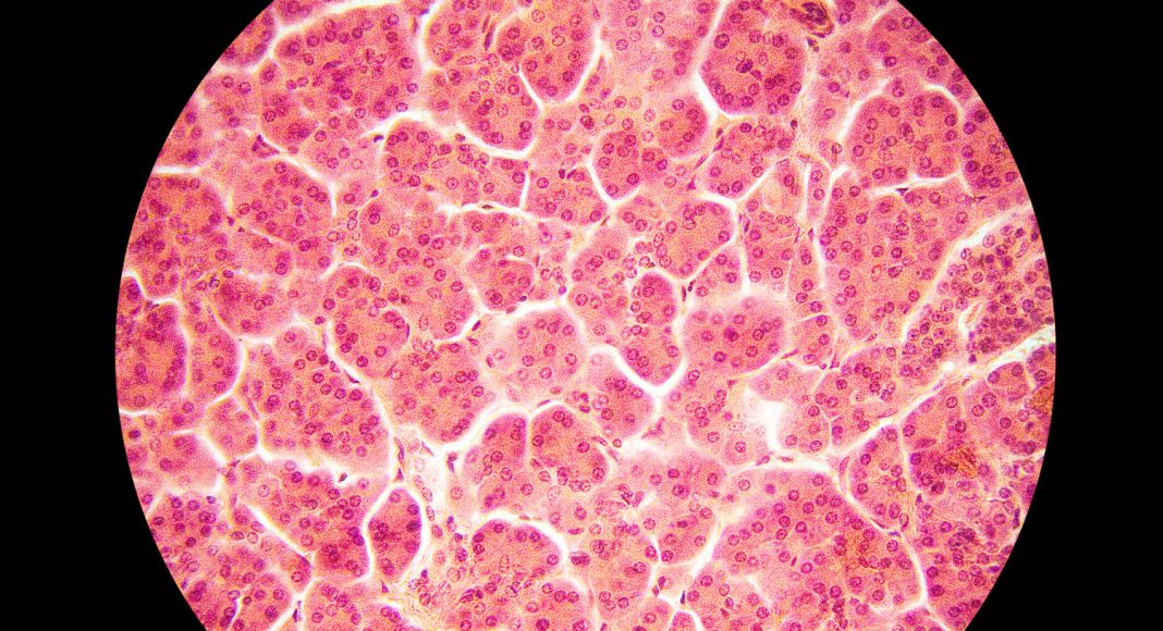 Pancreatitis