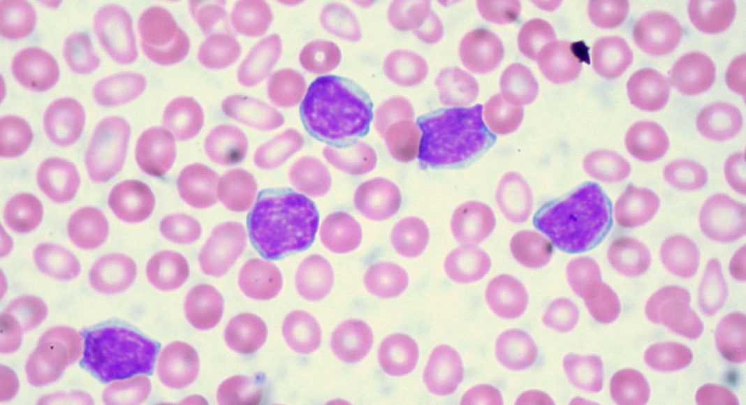 Leukemia
