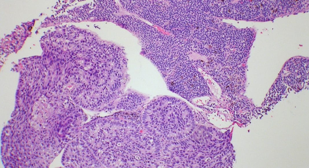Leukemia Cells