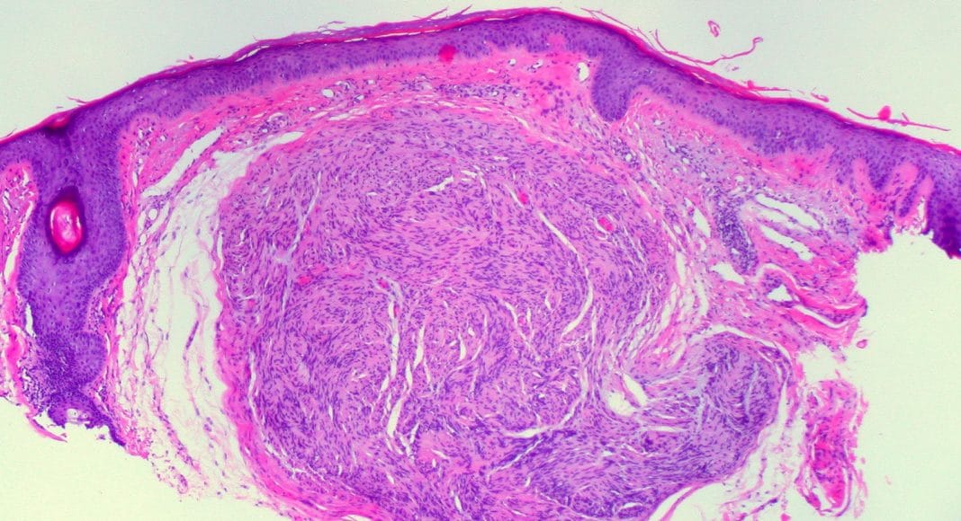 melanoma cancer cells