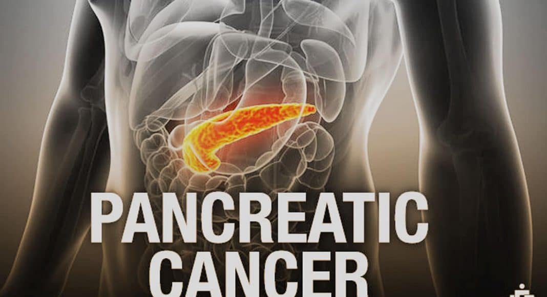 pancreatic cancer