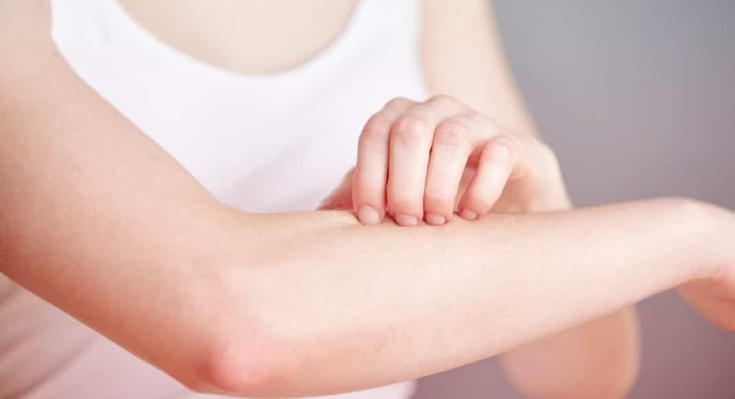 eczema