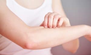 eczema