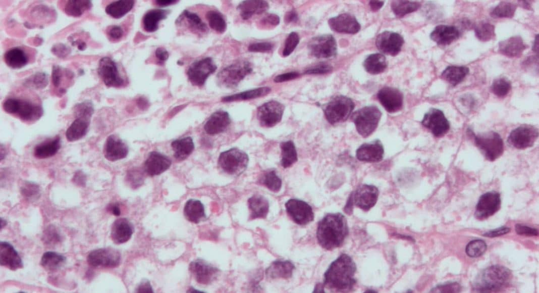 Testicular Cancer