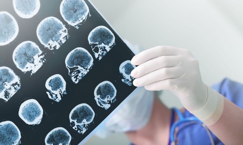 epilepsy and cannabis