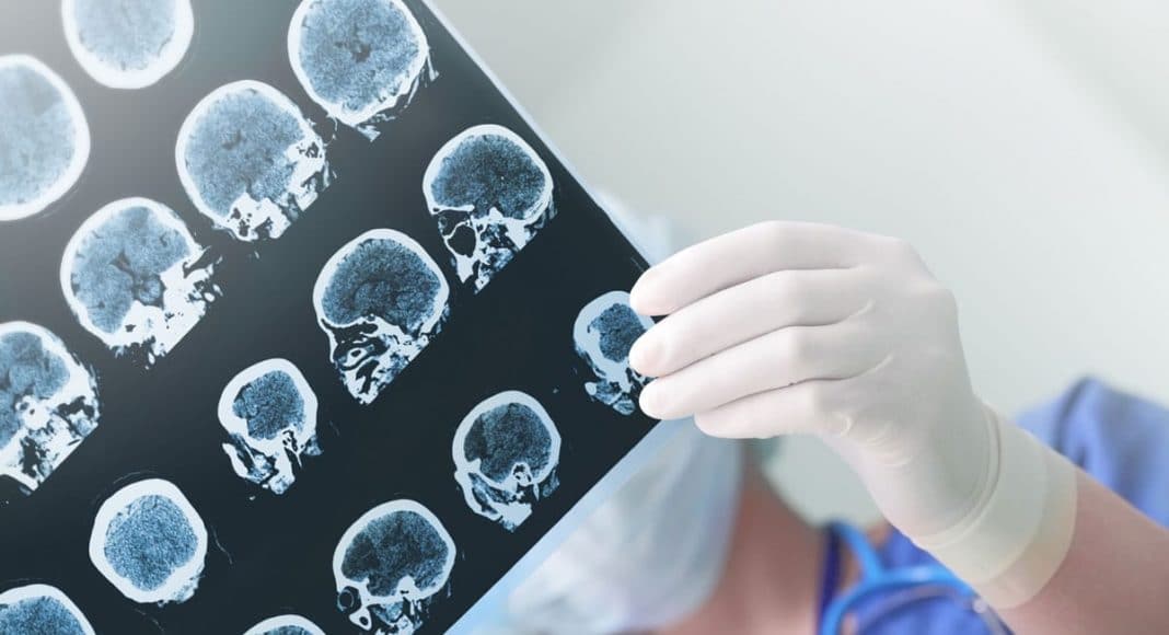 epilepsy and cannabis