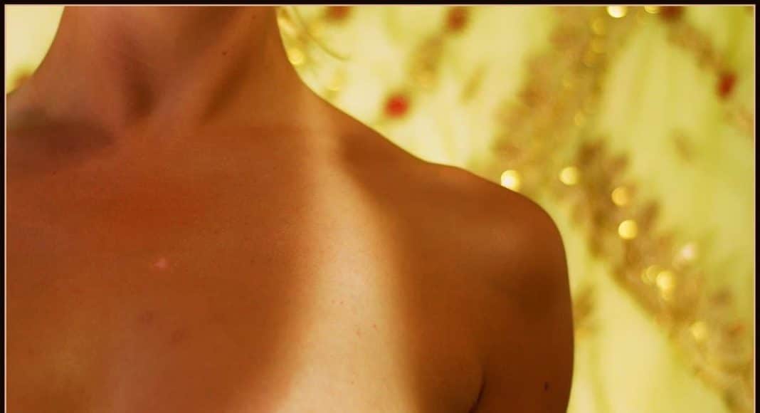 Summer Sunburn