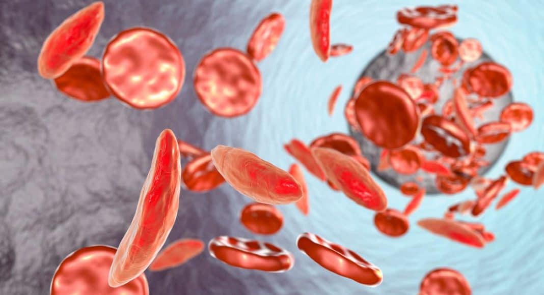 Sickle Cell Anemia