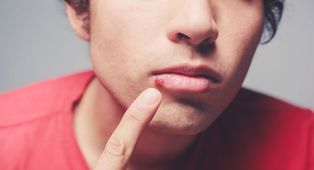 Marijuana Can Treat A Herpes Outbreak