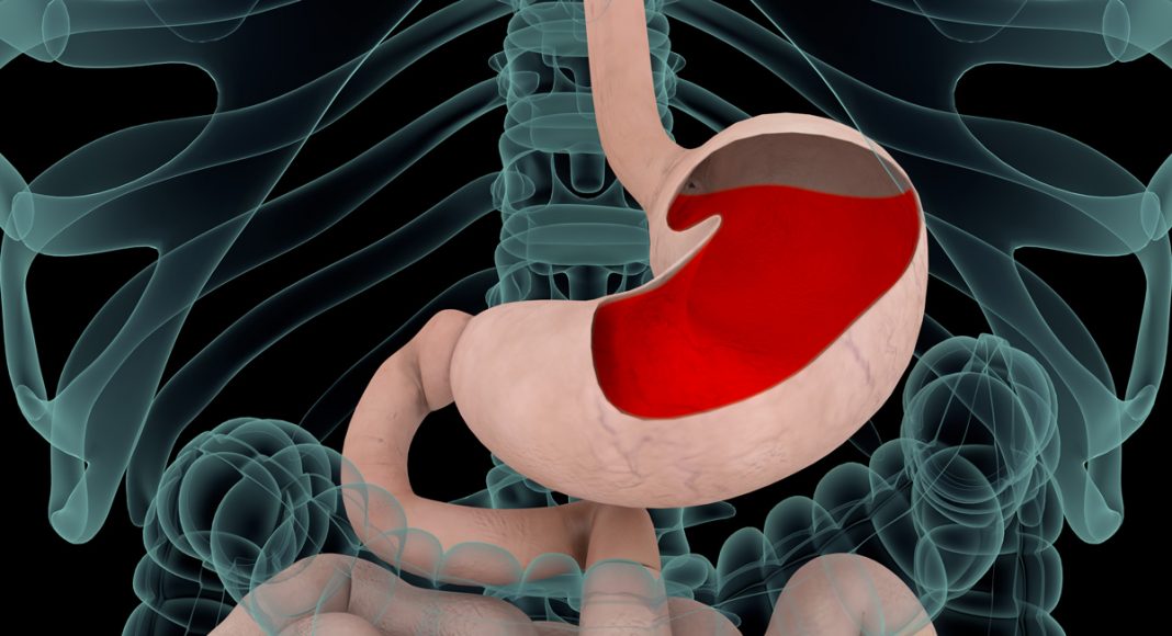 Can Cannabis Treat Gastroesophageal Reflux Disease (GERD)?