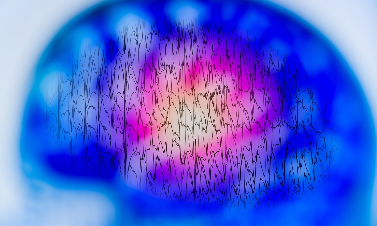 Epilepsy And The Latest Cannabis Research