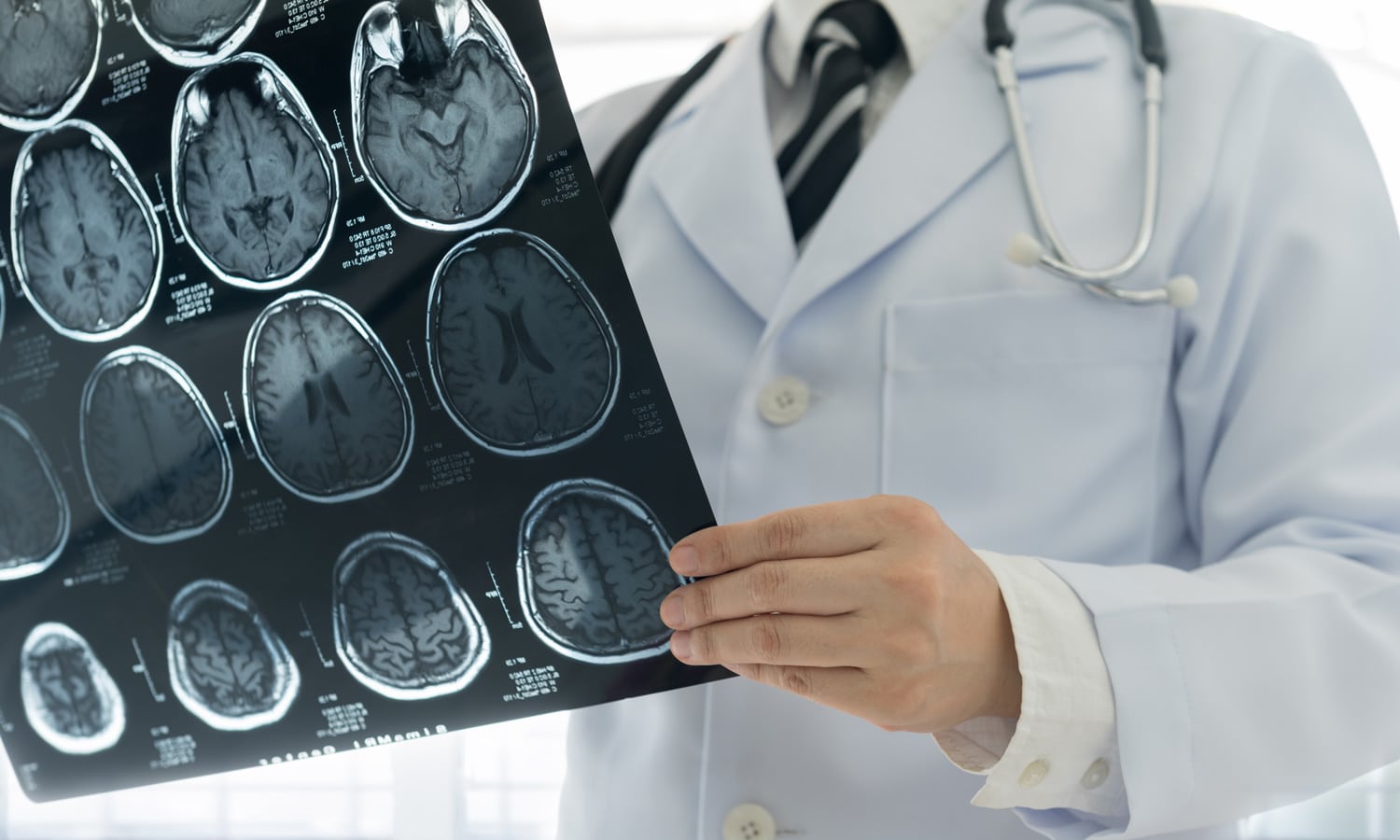 No Evidence Marijuana Increases Stroke Risk, Study Finds