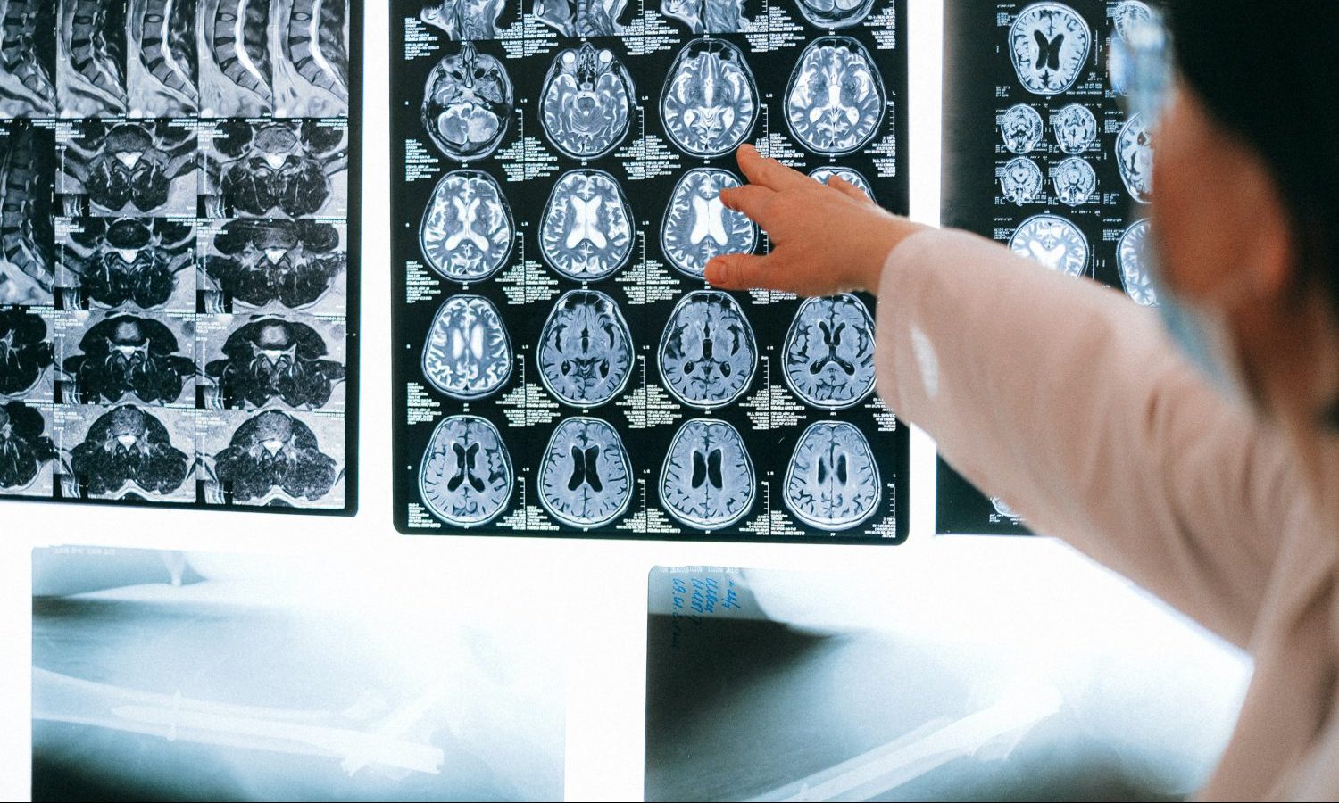 Losing Inhibition After Brain Trauma