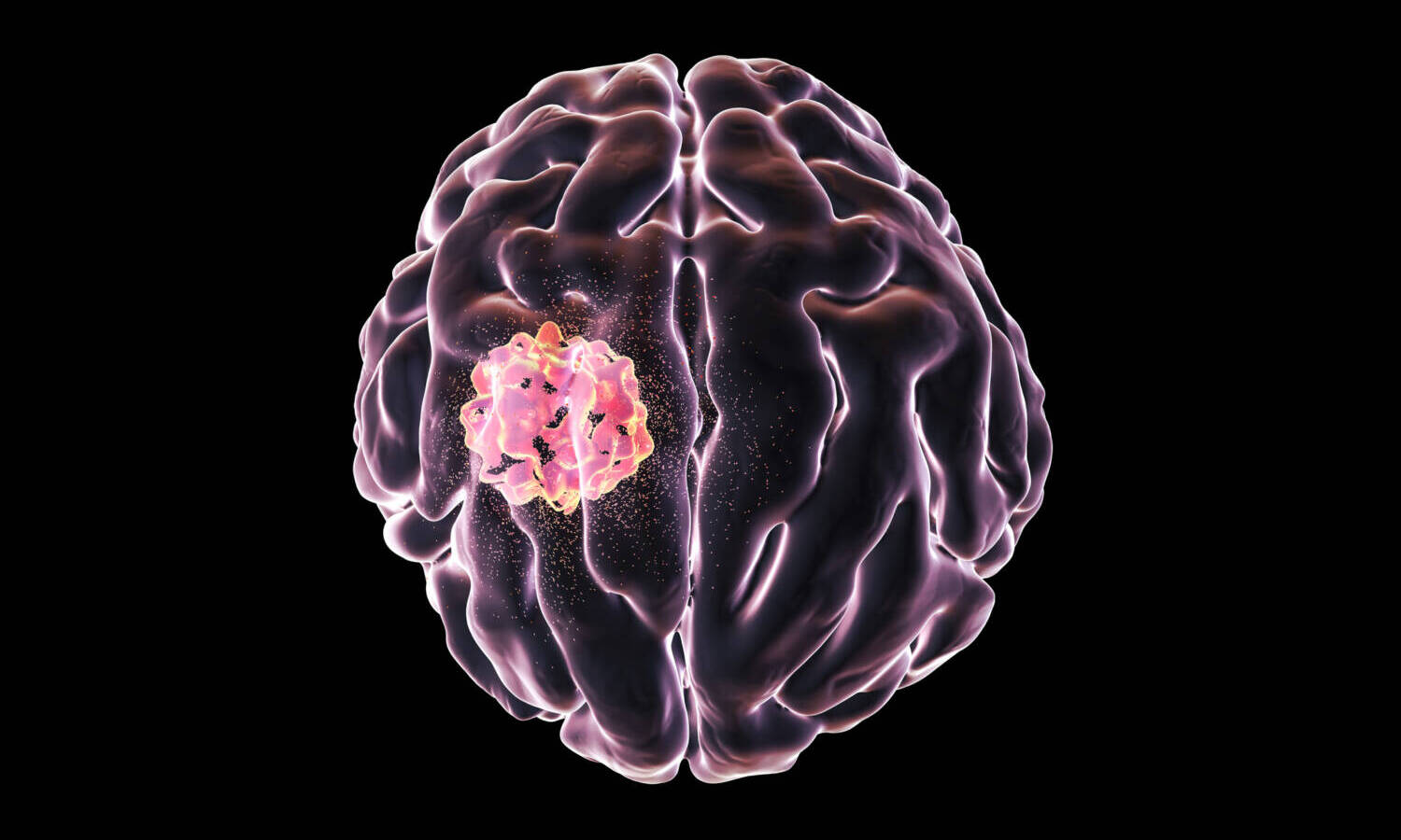 brain tumor cancer