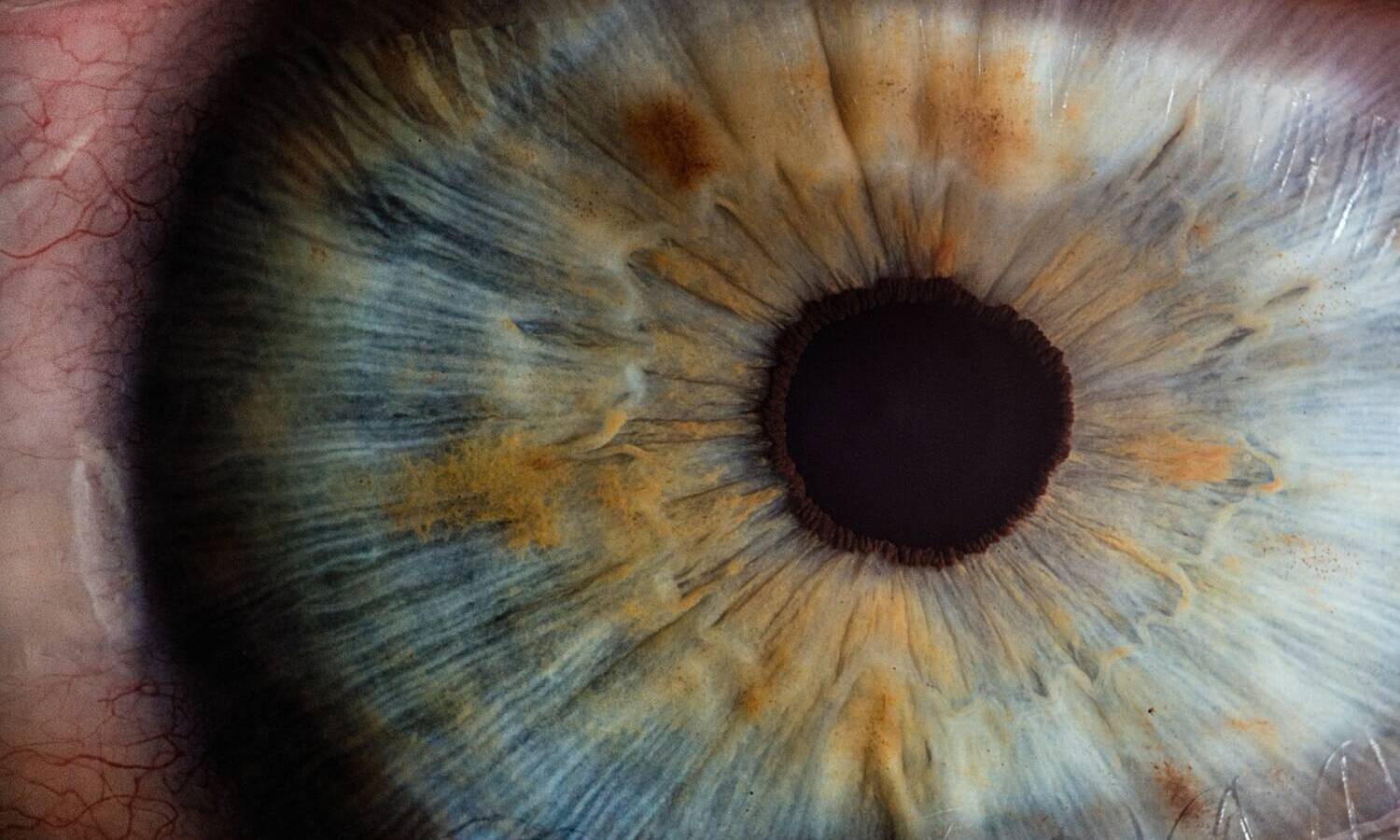 glaucoma