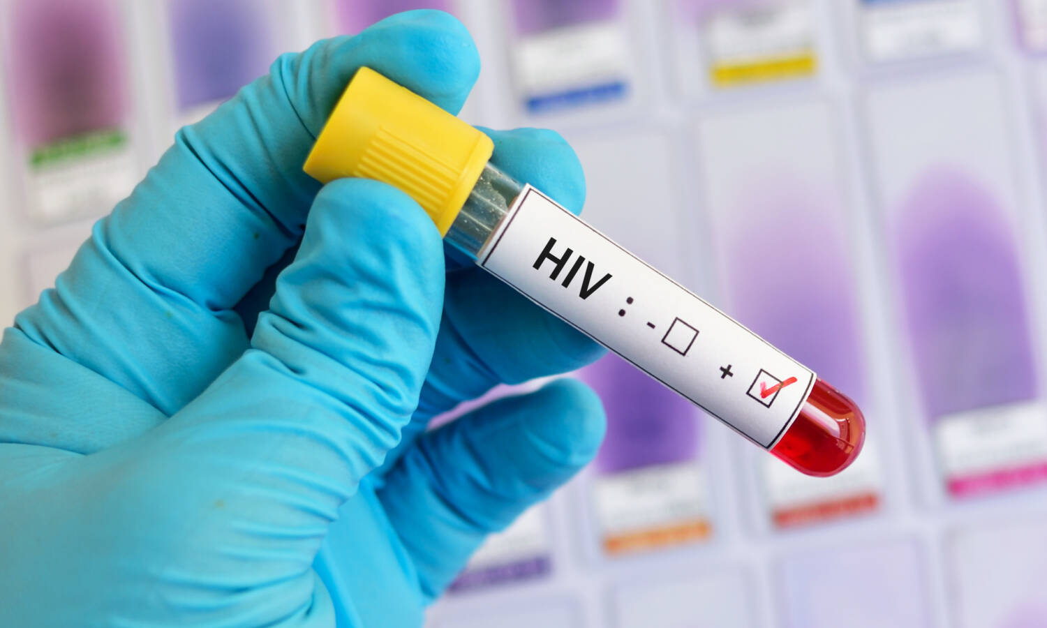 HIV AIDS