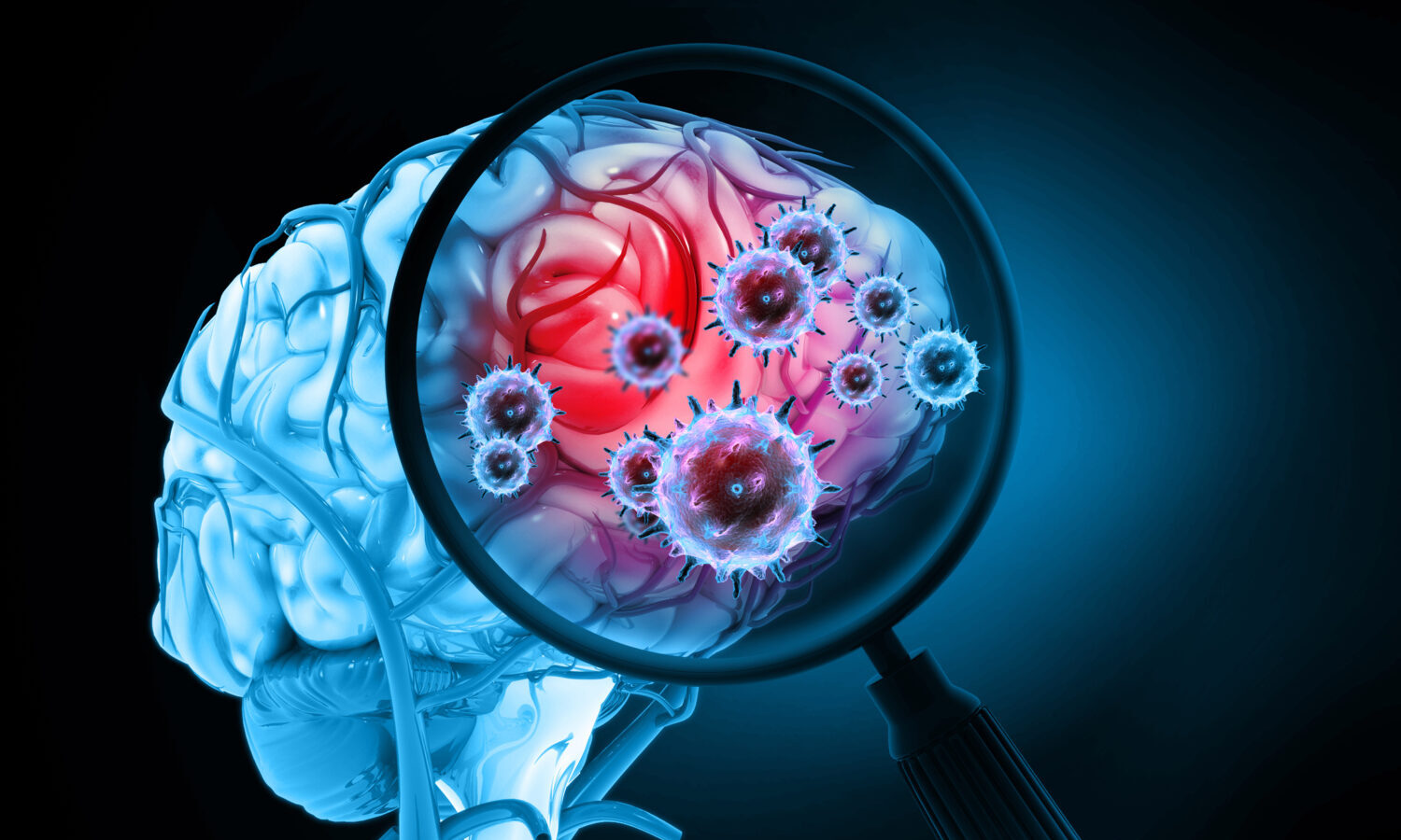brain infection