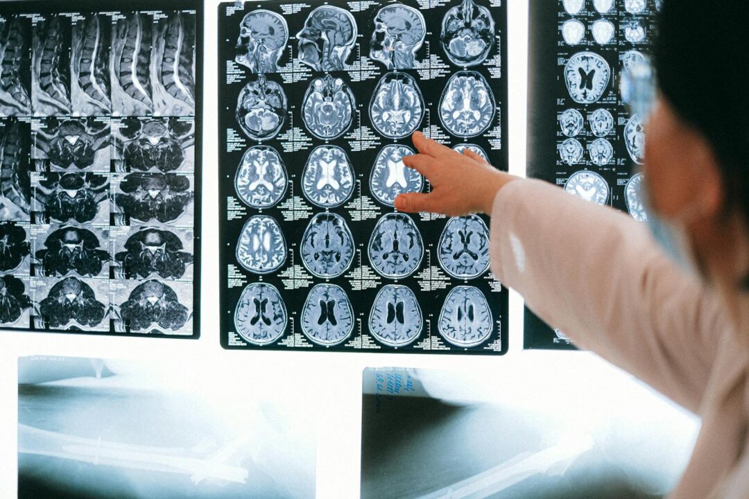 Can Cannabis Help Make The Brain Younger