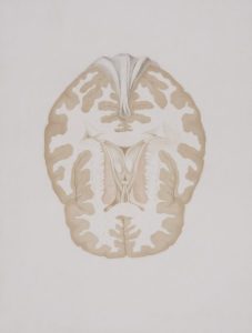 What To Know About Cannabis And A Brain Aneurysm